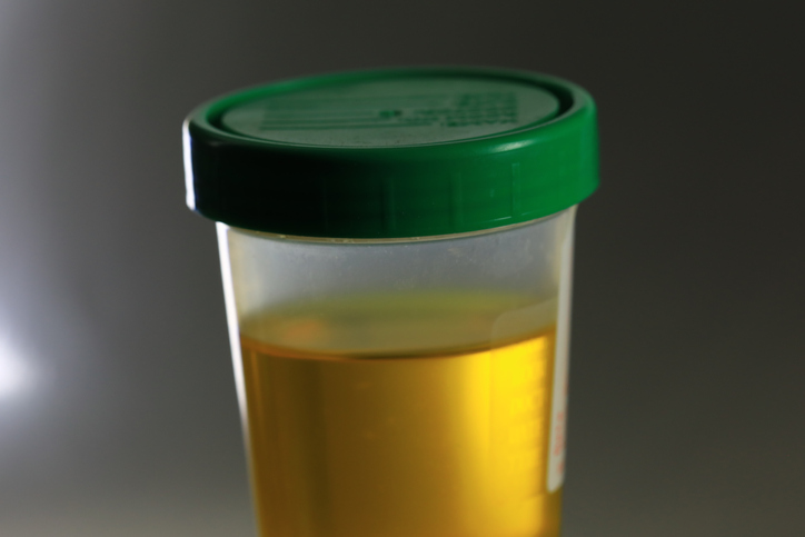 urine analysis 