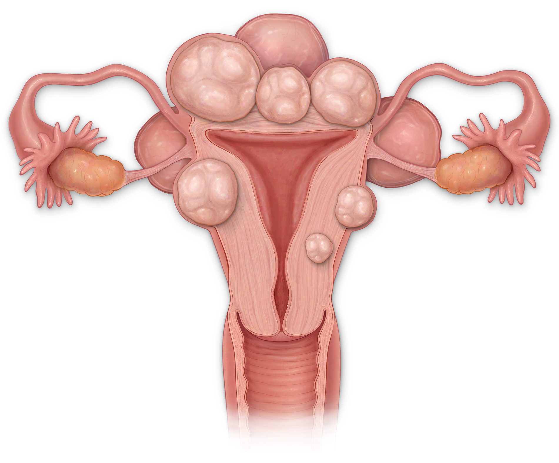Female anterior cross sectional view of a uterus with fibroids, vagina, cervix, fallopian tubes and ovaries