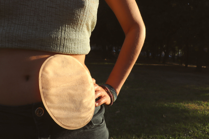 A woman with a colostomy bag on her belly
