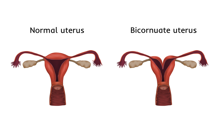 Tiffany Haddish heart shaped uterus pregnancy miscarriages bicornuate fertility complications