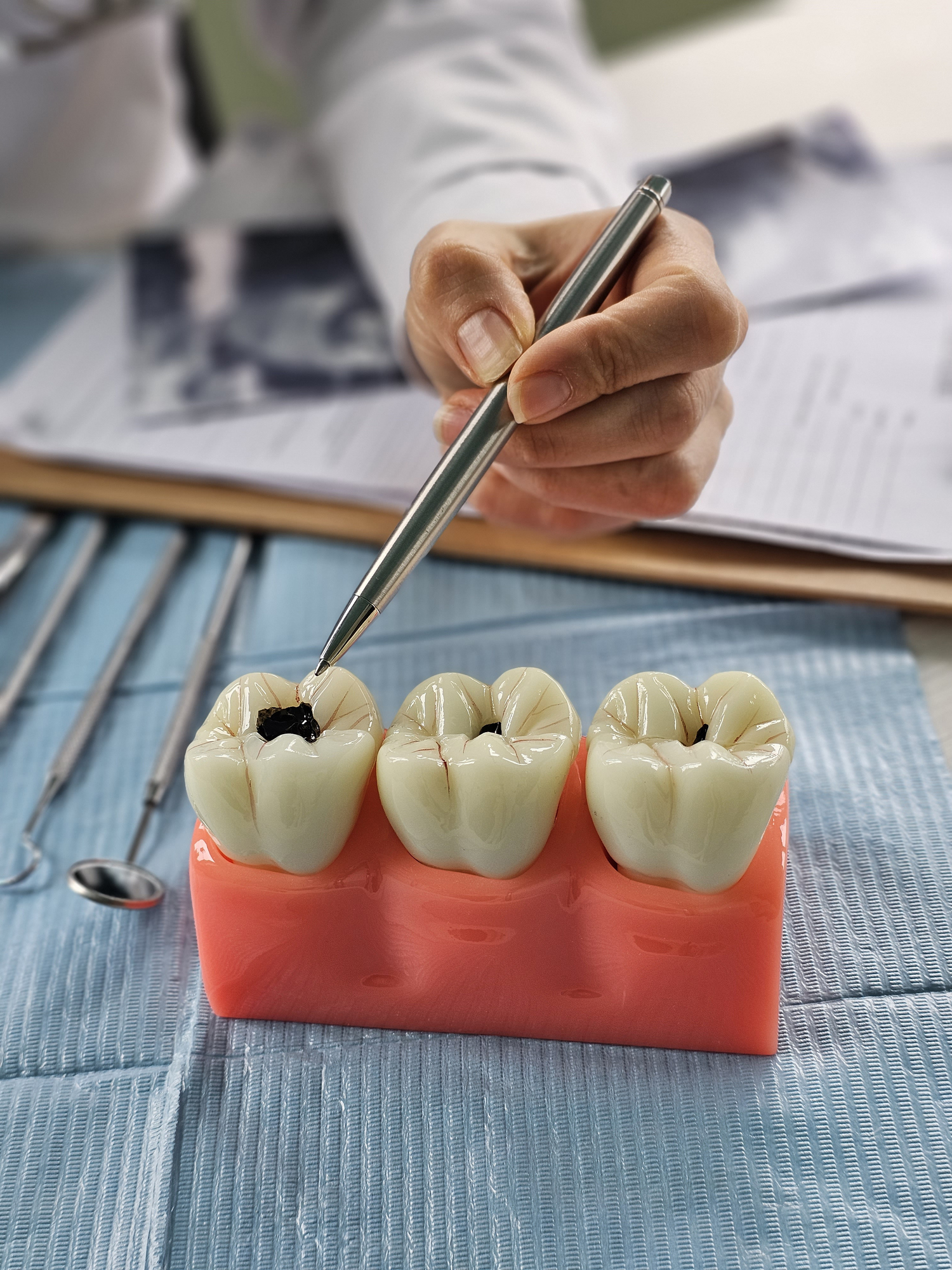 Dental professional demonstrating cavity filling technique on dental model