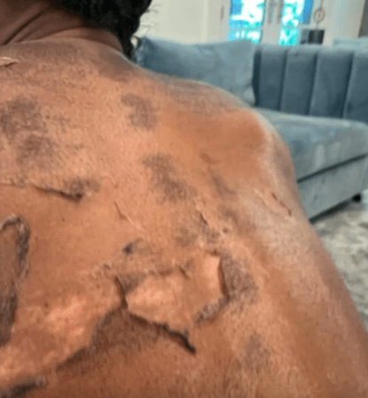 Shamea Morton, chemical peel, pretty faces atlanta, Dr. Jing Jing Wong Harris, lawsuit 