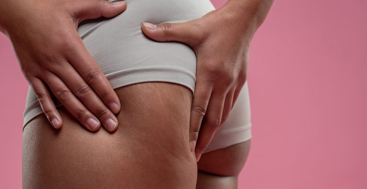 Close up of woman checking her legs on cellulitis