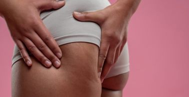 Close up of woman checking her legs on cellulitis