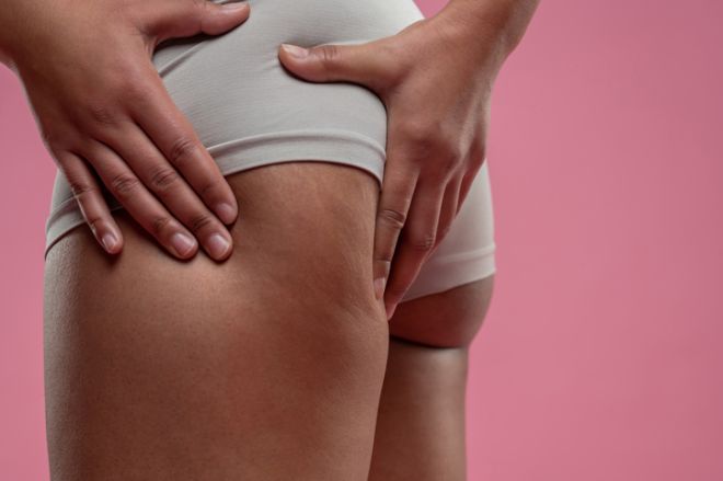 Close up of woman checking her legs on cellulitis